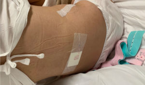 東京衛生病院の無痛分娩の記録。背中に麻酔の針を刺されたシーン。